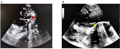 The relationship between the PICC tip position and weight gain, length growth of premature infants under ultrasonography: a correlation analysis study